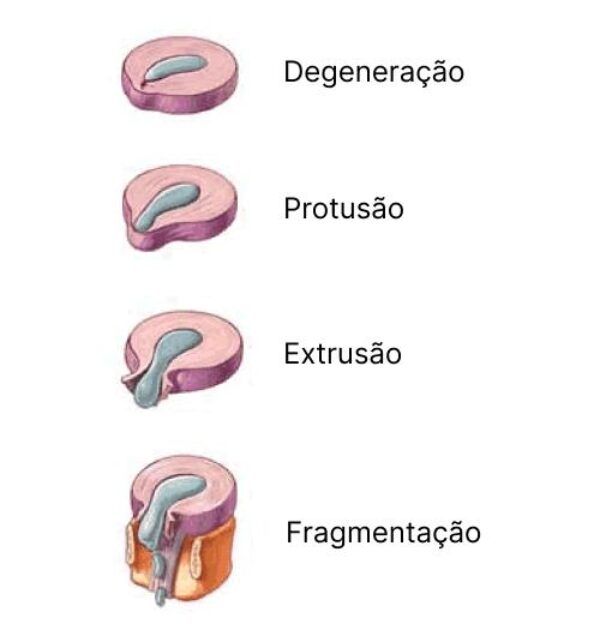 Quiropraxia para Protusão