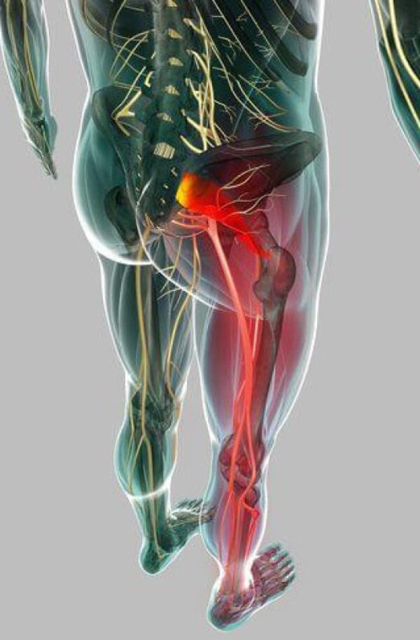 Quiropraxia para Síndrome de Piriforme